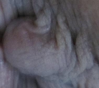痔の写真